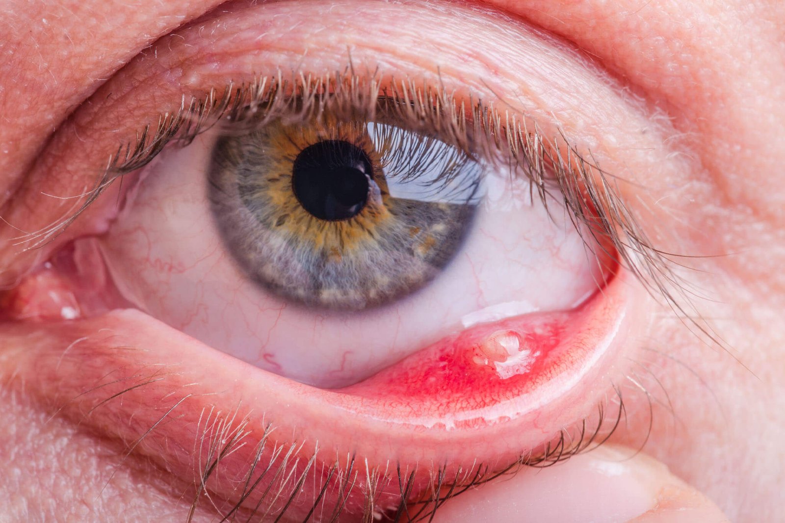 Best Chalazion Management in Gurugram